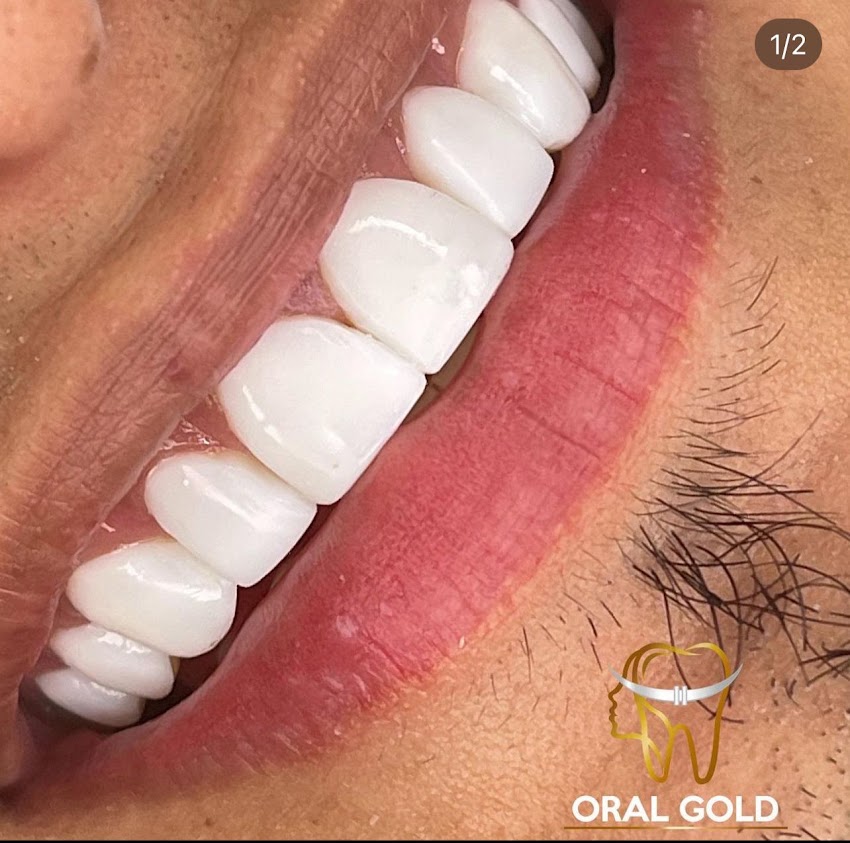 Oral Gold